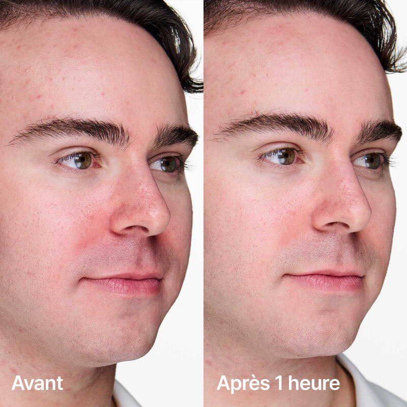 Anti-blemish Solutions™ Gel Anti-imperfections 3